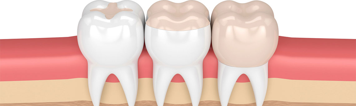 Dental Crowns in Elmhurst, NY